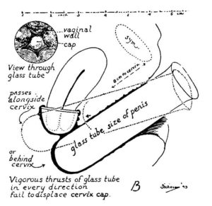 Robert L. Dickinson’s drawing of how he used a glass tube to mimic the thrusting of a penis to see if it displaced the cervical cap. Ernst Grafenberg and Robert L. Dickinson, “Conception Control by Plastic Cervix Cap,” Western Journal of Surgery, Obstetrics, and Gynecology 52 (August 1944): 339.